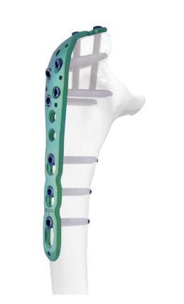 Ліктьова пластина ІІ, ліва ( Double Medical Technology Inc.)